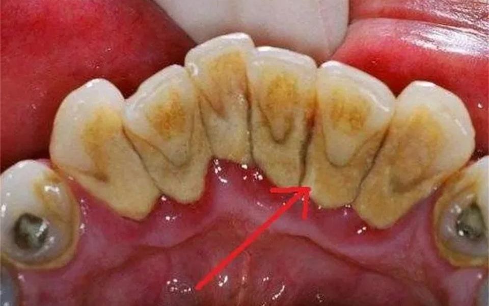 牙黄牙结石太难搞?跟我学会这几招,牙变白了牙石也唰唰掉!