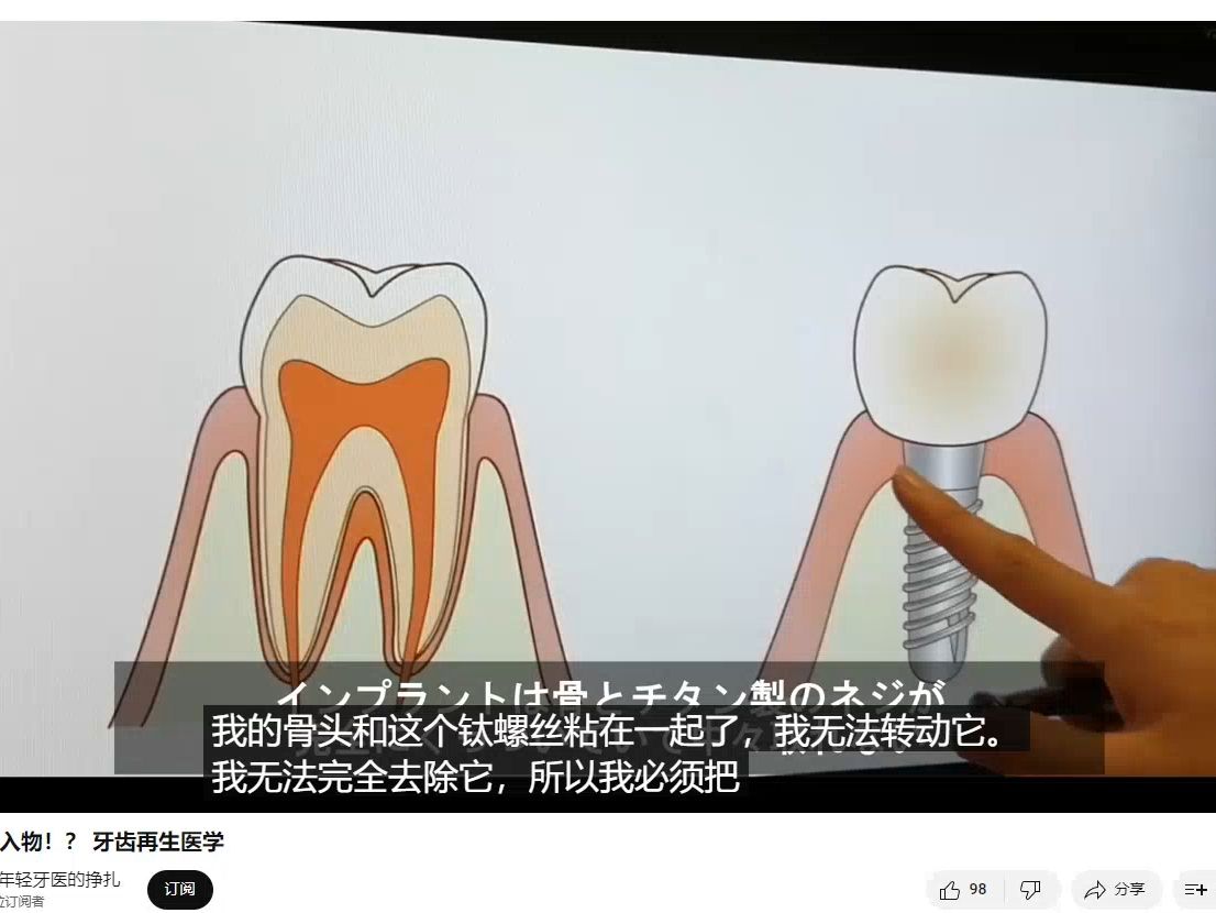 【下一代植入物?】日本牙齿再生医学哔哩哔哩bilibili