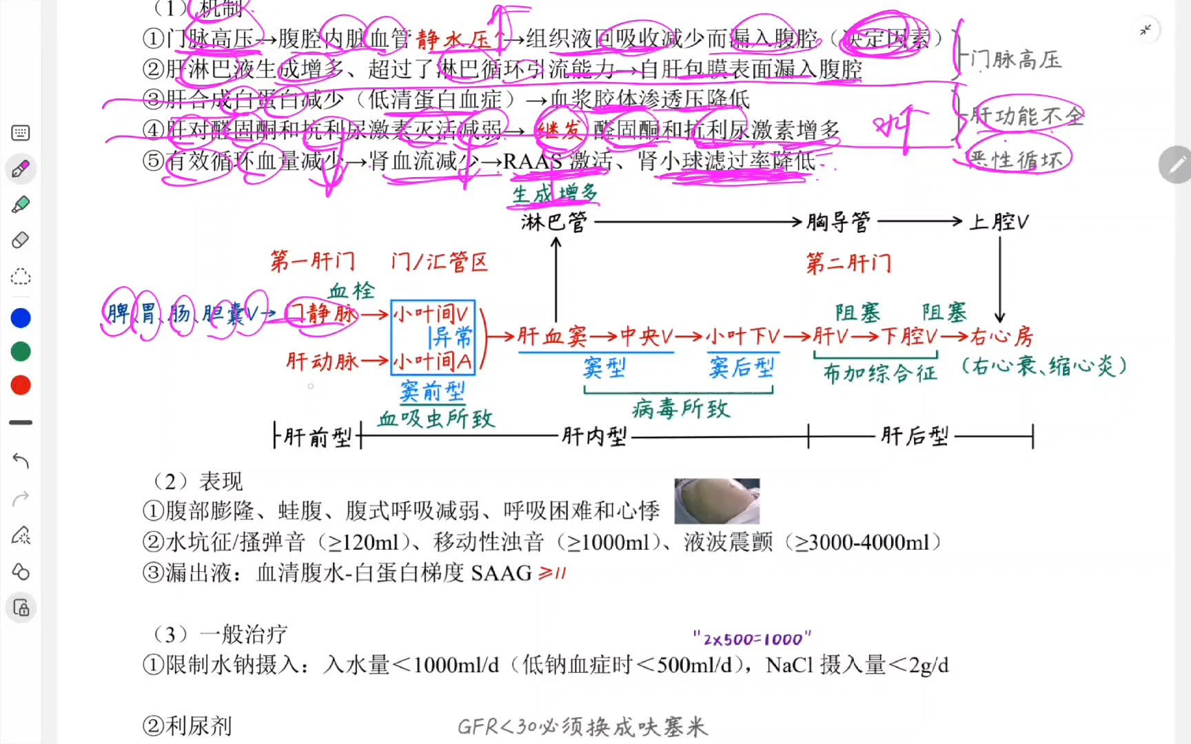 肝硬化机制图图片