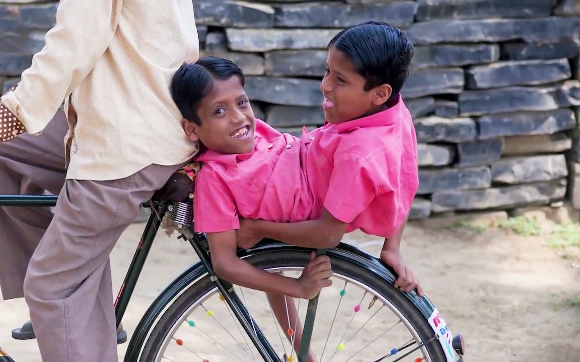 连体12年的双胞胎,拒绝医生的分开手术,父母说出缘由惹人落泪