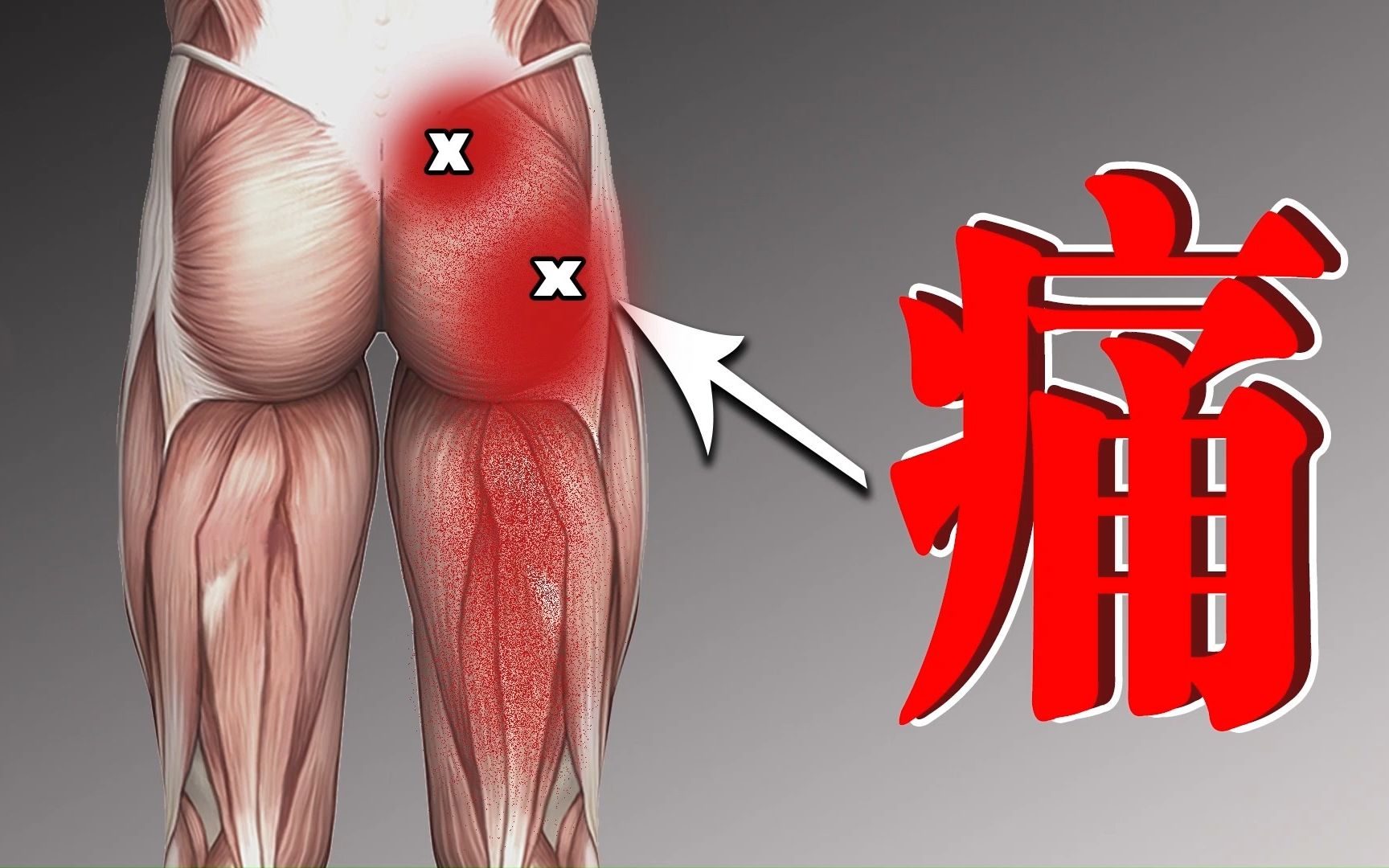 这里经常痛?尝试2个动作,有效改善坐骨神经痛,一周见效哔哩哔哩bilibili