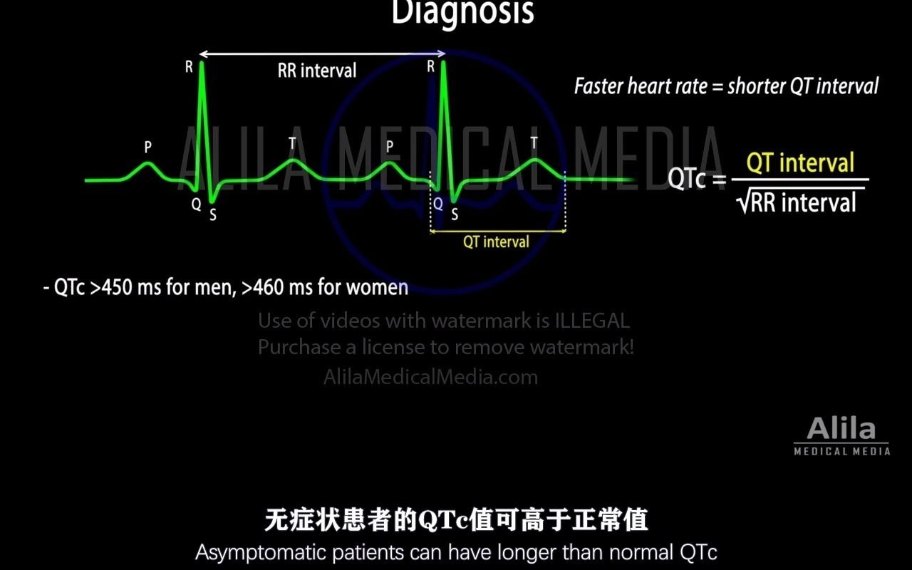 【Alila Medical Media】19.长QT间期综合征(LQTS)哔哩哔哩bilibili